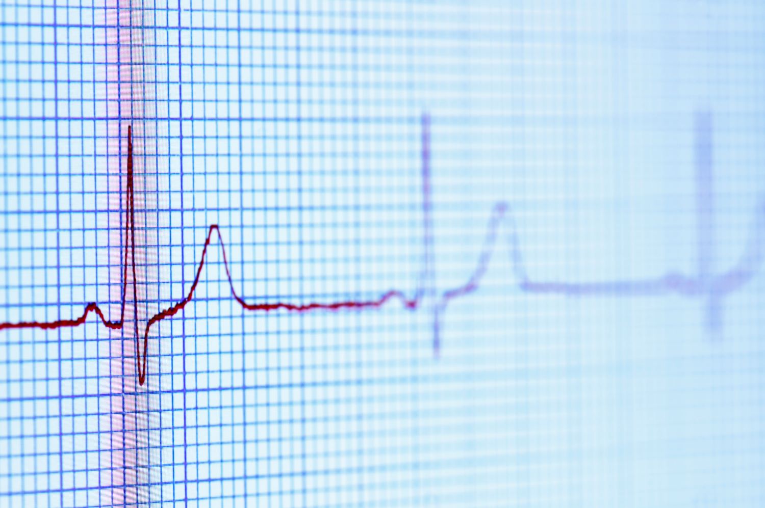 ekg ปกติ